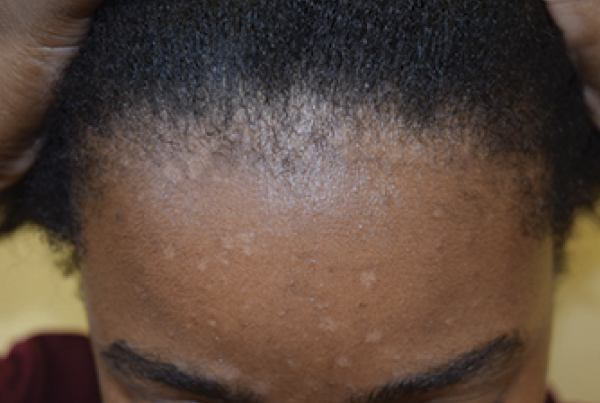 Hypopigmented macule and patches on the face of an African American female with seborrheic dermatitis